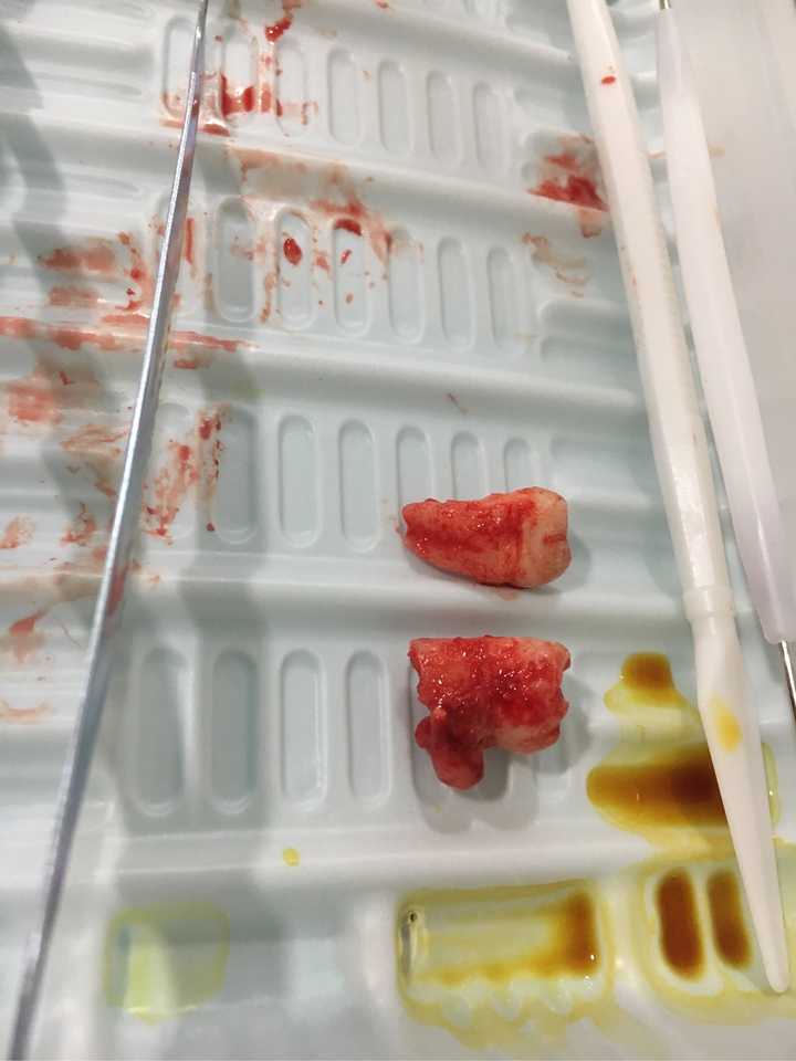 智齿变成含牙囊肿?