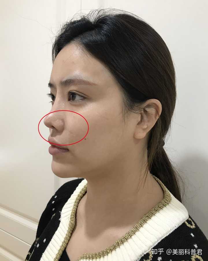 鼻基底凹陷,可以采用注射填充,假体填充和自体软骨材料垫鼻基底方式