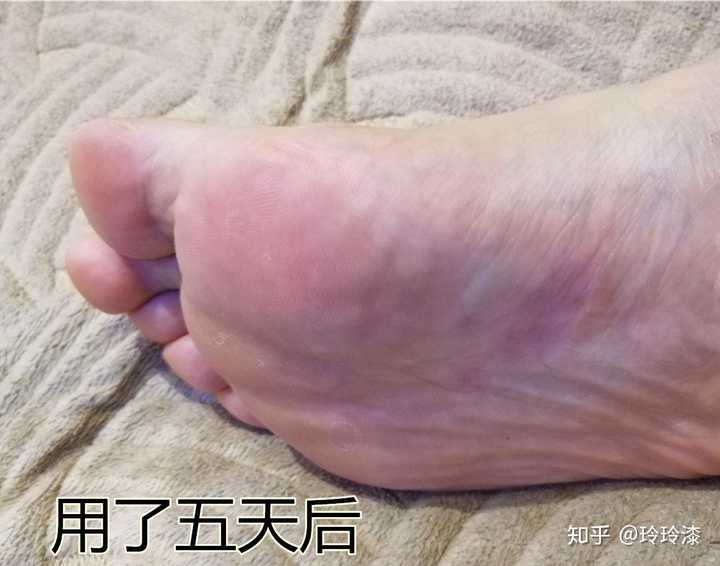 女生有脚气是怎样一种体验?