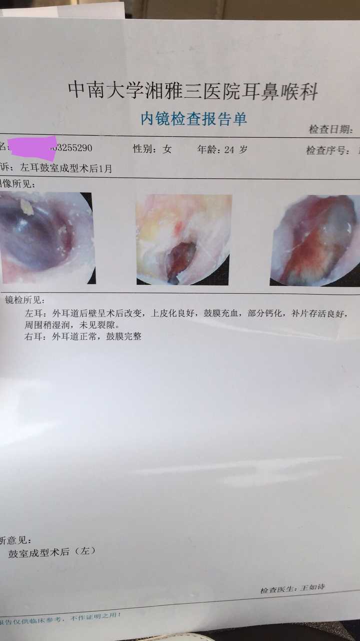 鼓膜穿孔修补手术有人了解么?具体有哪些风险?