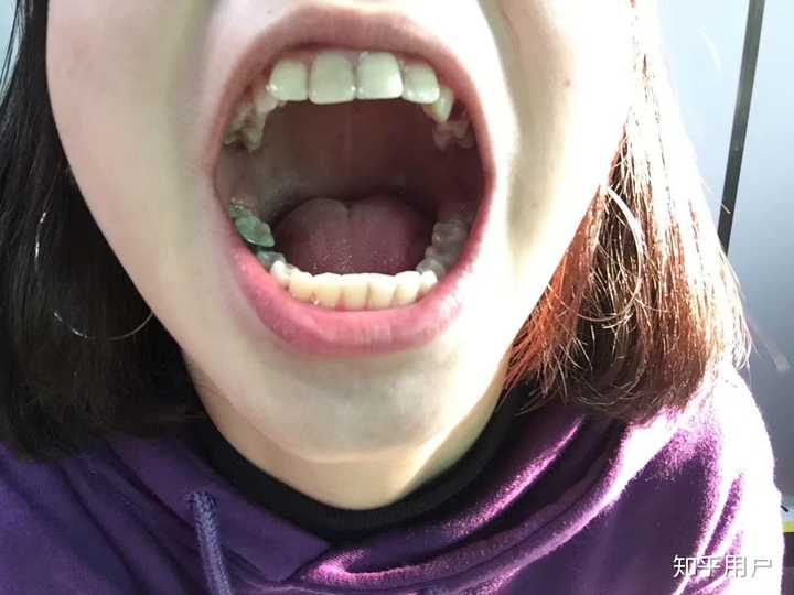 大概隔一个月或者两个月?的复诊,可以看到上排牙齿明显有弧度了