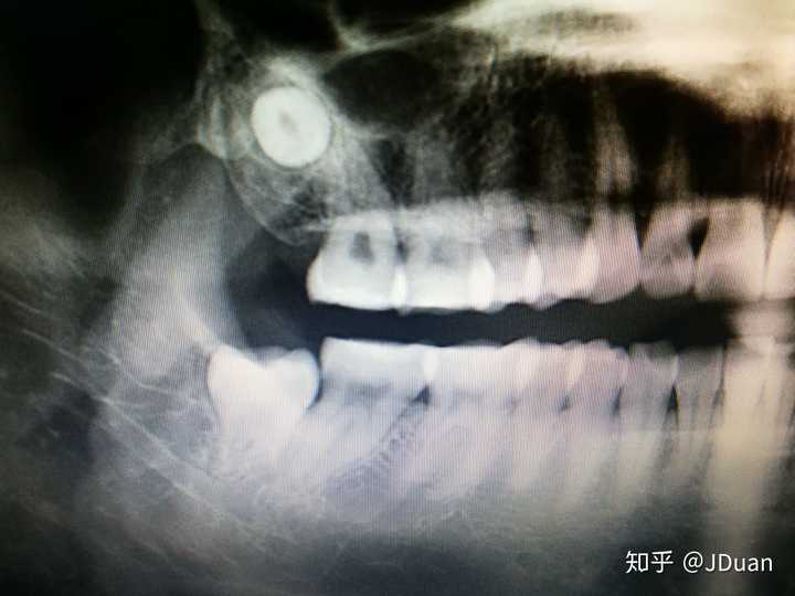 智齿横长,右上颌吃东西已经有点疼,请问如何处理?有图