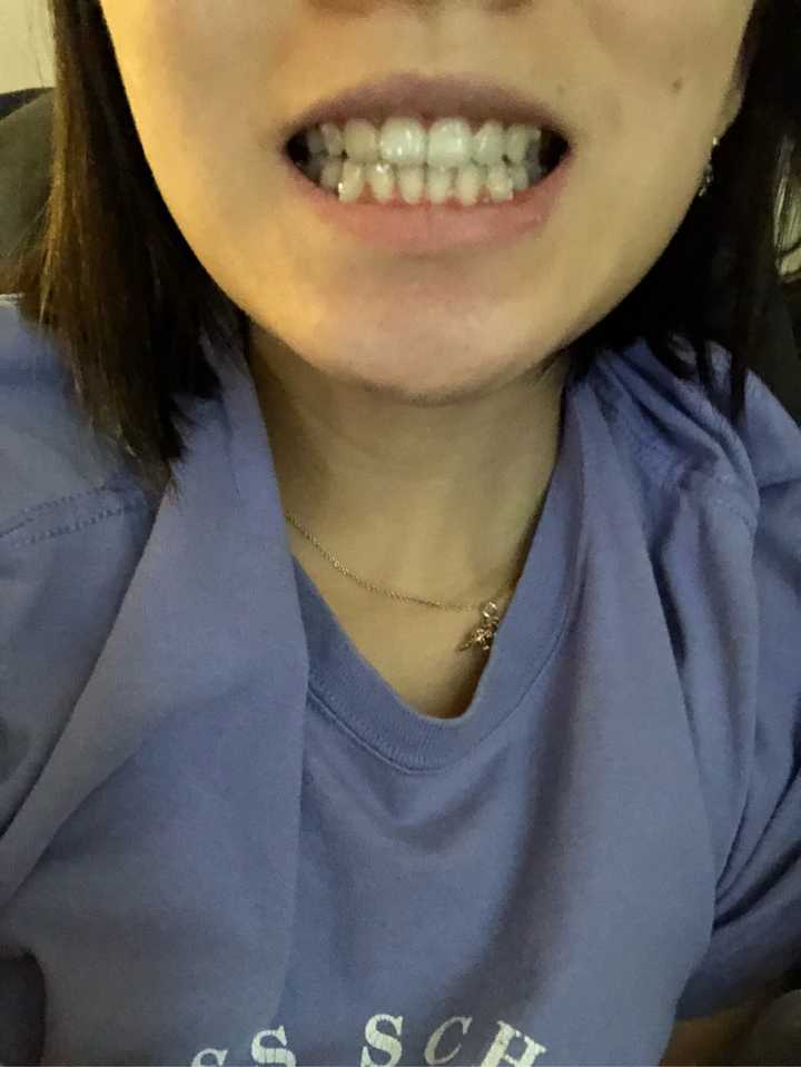 戴牙套的过程是怎样的?有什么危害?