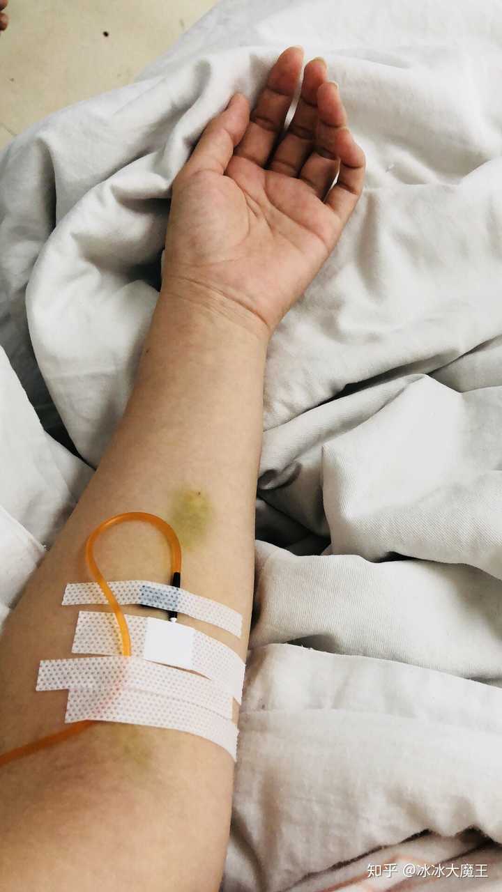 骨折是一种怎样的体验?