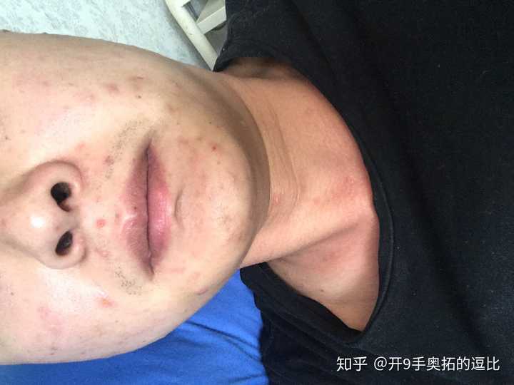 长水痘是一种怎么样的体验?
