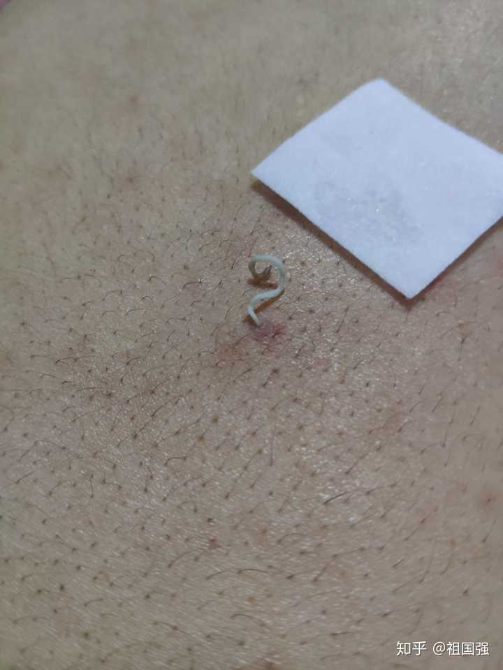 史上最大的黑头有多大?