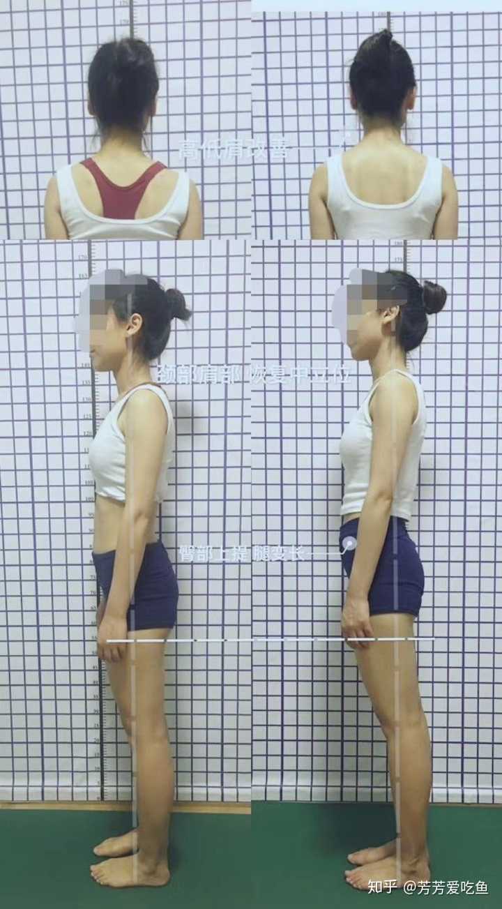 高低肩高低肋骨如何康复锻炼调整?
