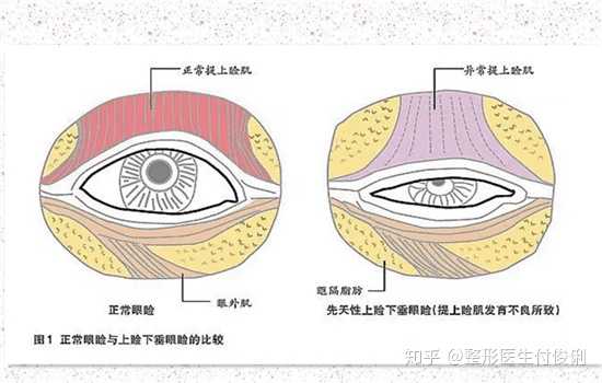 上睑提肌手术如何保证永久效果