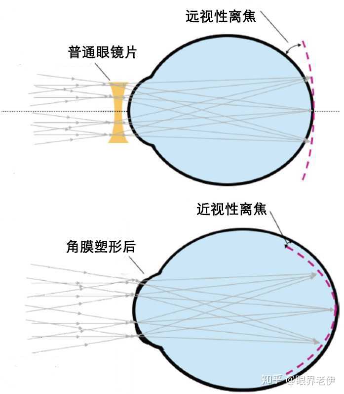 近视通常会表现出 周边远视离焦,当使用眼镜镜片或常规隐形眼镜校正