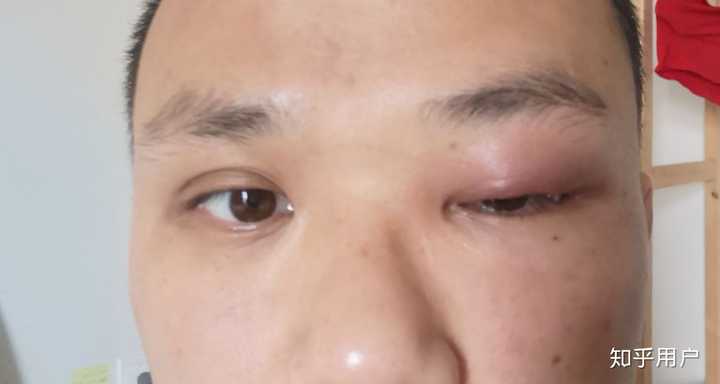 手指缠线是否对麦粒肿有疗效?