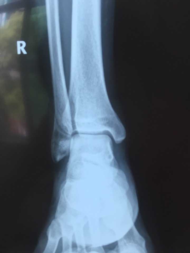 腓骨靠近脚踝端骨折90天,刚拆石膏,骨折线仍可见,图为