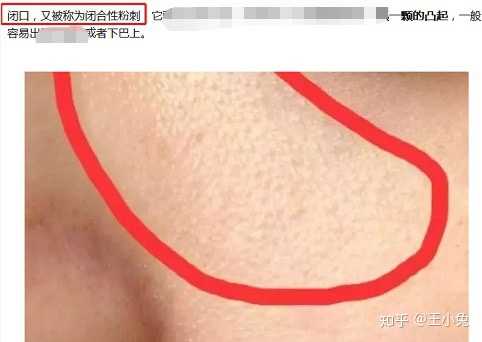 提问:这两个是闭口吗?