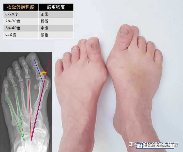 为什么有的人大拇脚指头会压着旁边的指头?