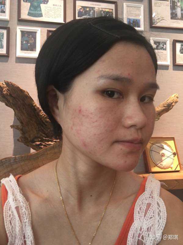 使用阿达帕林后,皮肤非常干燥脱皮,灼烧疼痛,而且脸特别红?
