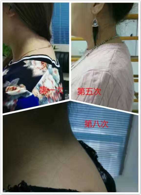 19岁驼背,从小习惯不好,拍过片子看到骨头已经弯曲,还