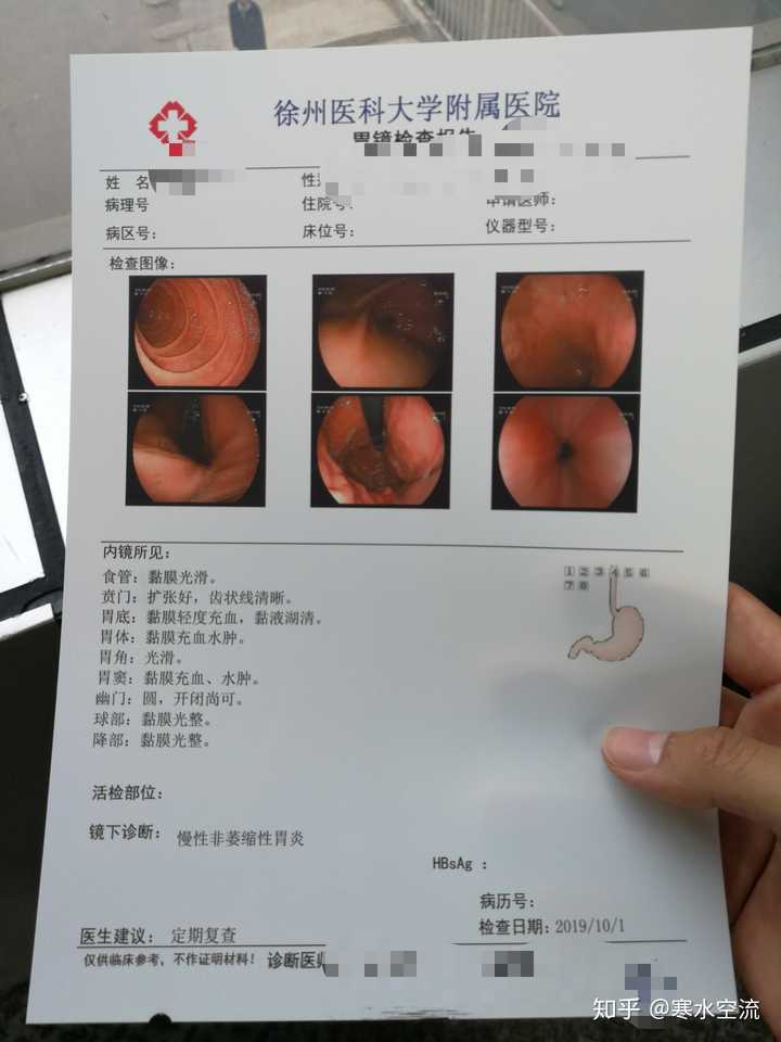 普通胃镜是什么感觉,很痛苦吗?