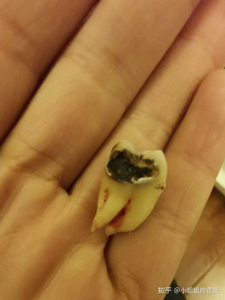 拔智齿是怎样怎样的体验