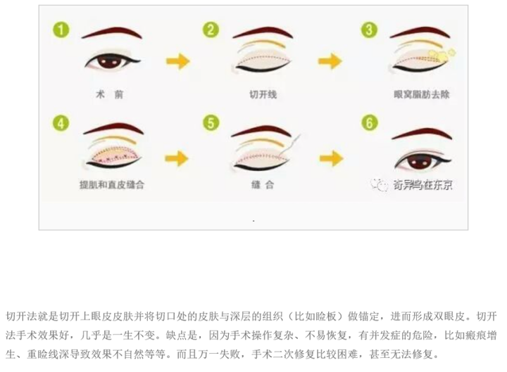 现在目前双眼皮手术有四种:埋线法 ,缝线法,切开法,微创小切口法