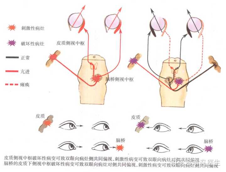 如何区分周围性眼肌麻痹与核间性眼肌麻痹?