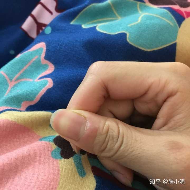 甲周疣最佳治疗方法是什么?