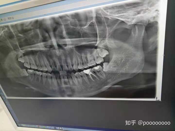 为什么两年前拔了智齿,现在同一个地方又长出来了一颗?