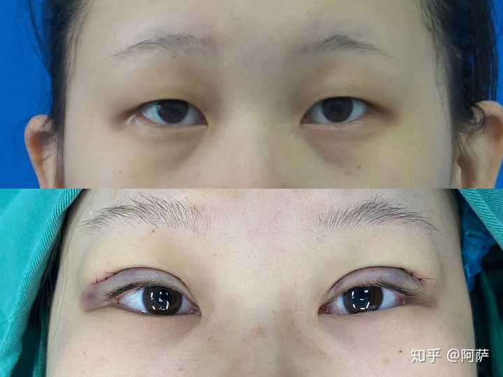 双眼皮拆线以后会自然很多吗?