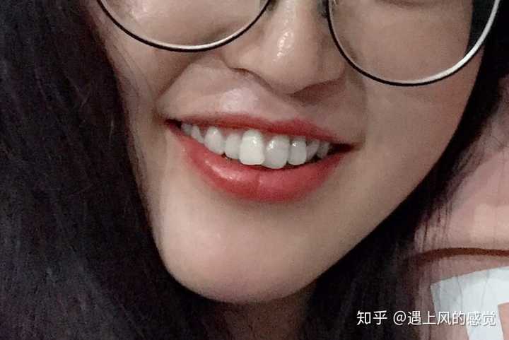 女生矫正牙齿是怎样一种体验?