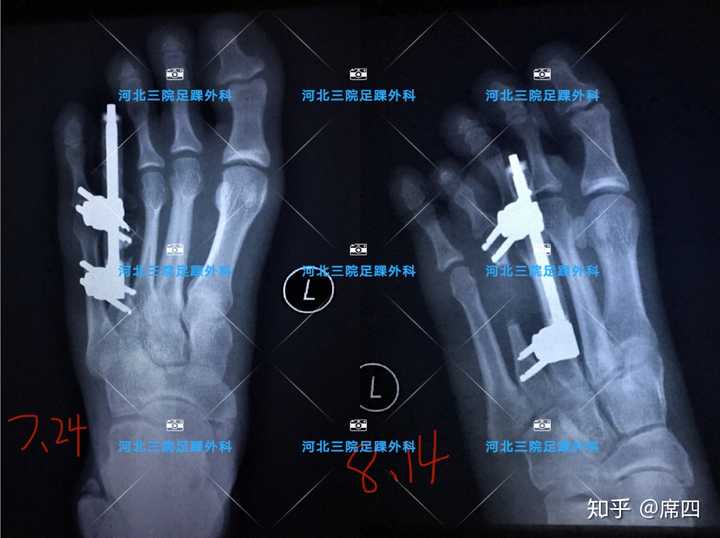 通常采用手术治疗,手术的目的是将短缩的 跖骨延长,从而达到第四趾