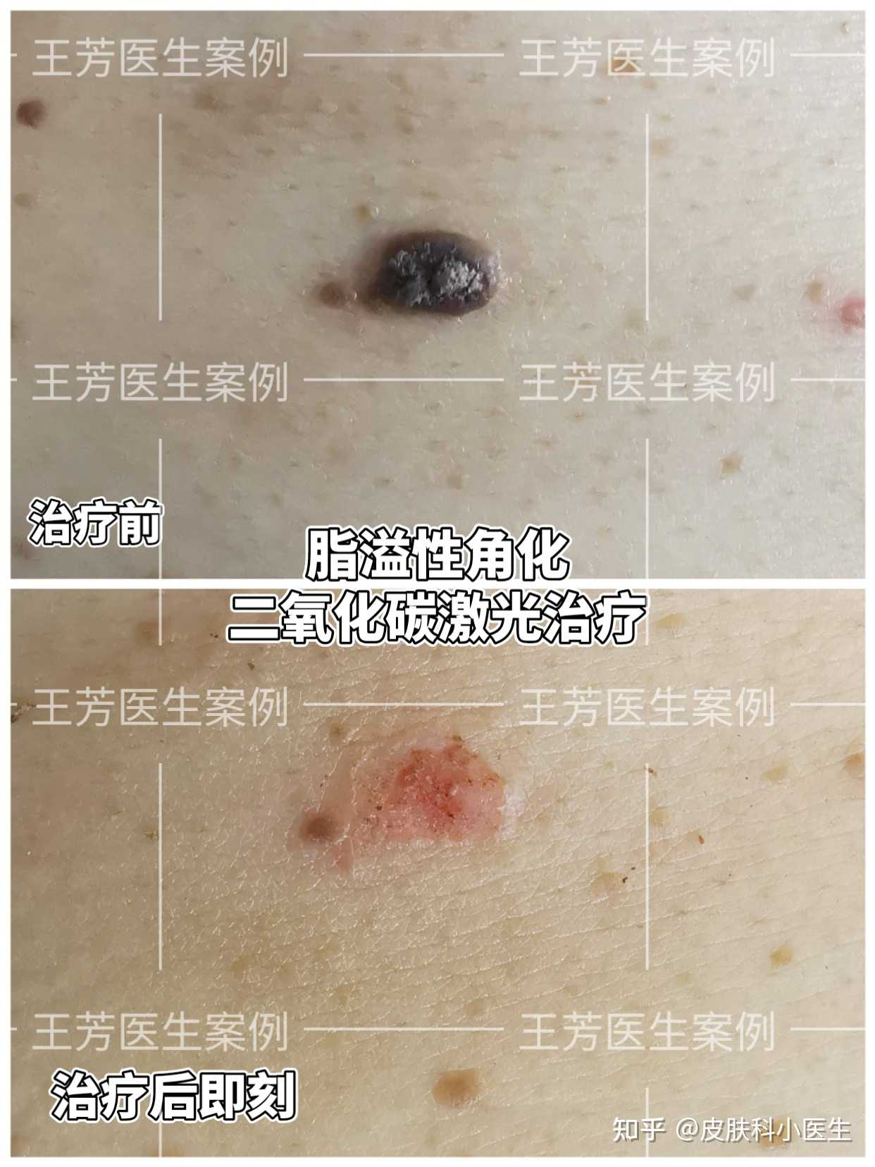 皮肤科小医生 的想法: 科普/案例: 脂溢性角化病又称老年疣,老