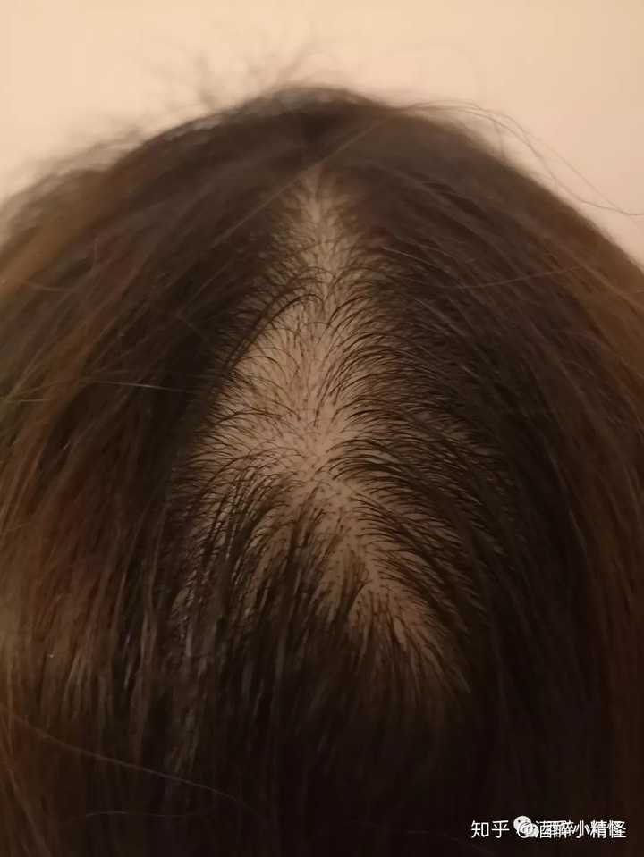 女孩子脱发怎么办 ?