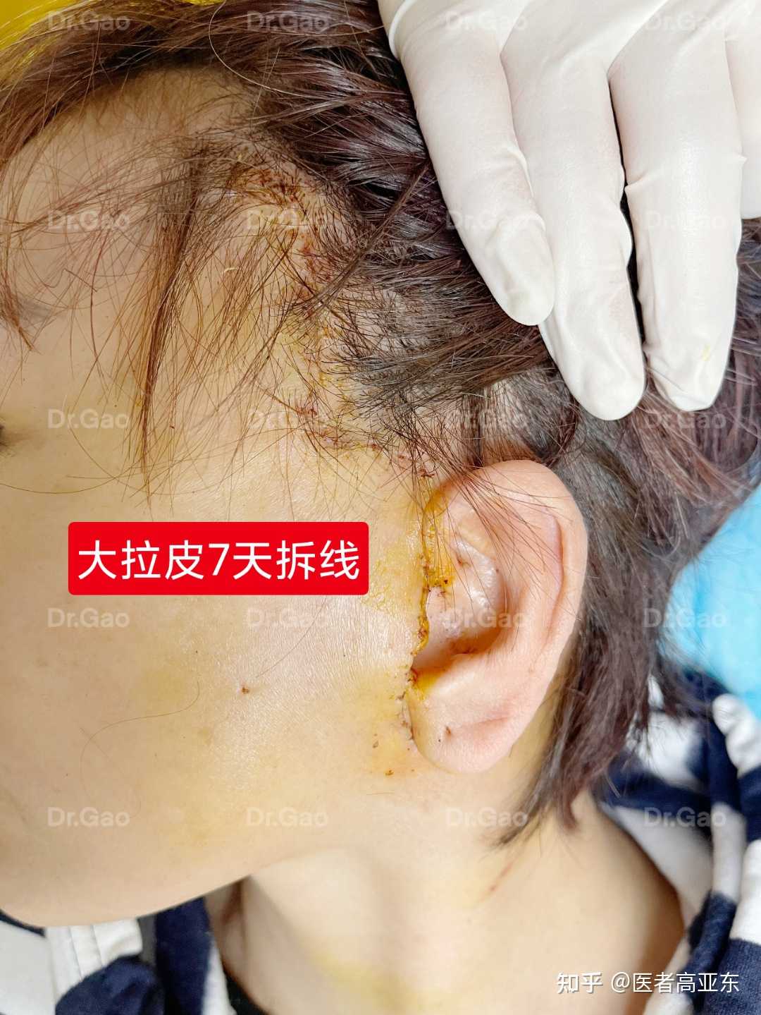 医者高亚东 的想法: 发际线,耳前切口大拉皮提升7天拆线,皮… - 知乎