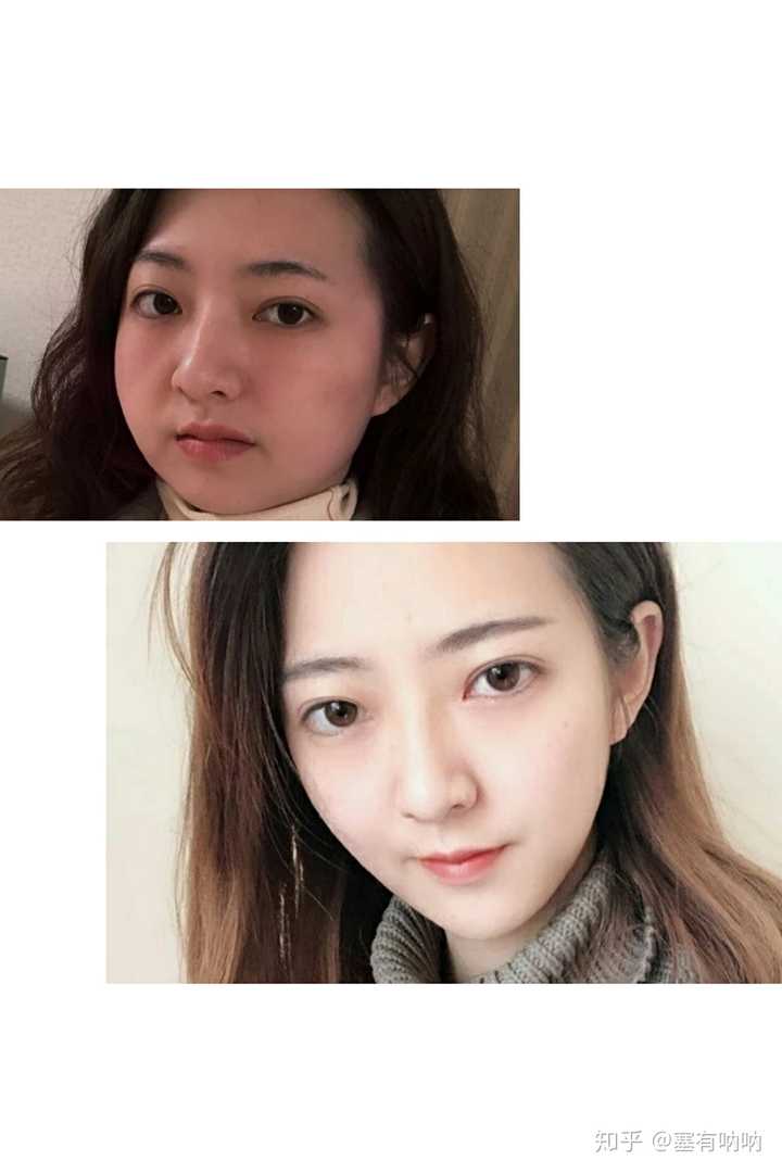 那种吸脂效果最好?有哪些吸脂方式?
