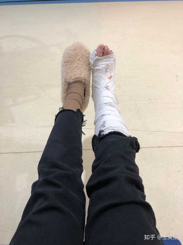 17中午刚自己把石膏拆了,脚上青紫青紫的有点吓人,跑了脚之后好点了