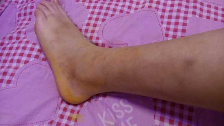 得过结节性红斑的人过来交流下?