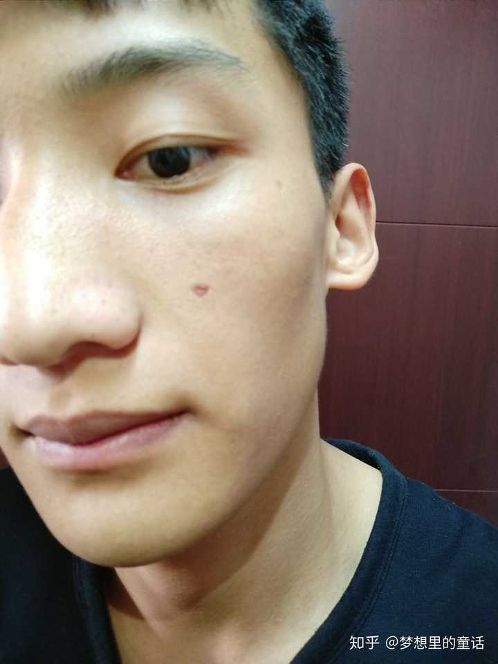 下面是点痣第一天到现在的几张图,希望有点痣的朋友可以参考一下.