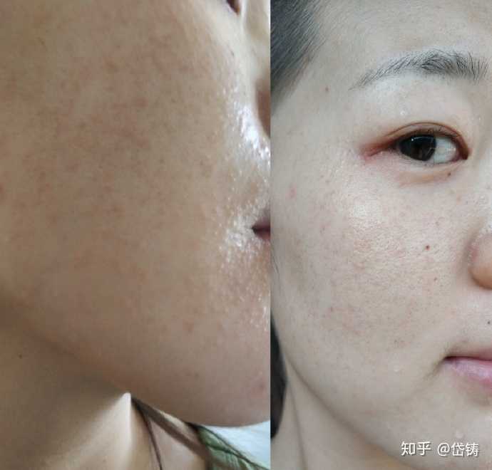 过敏性皮炎可以洗澡么?