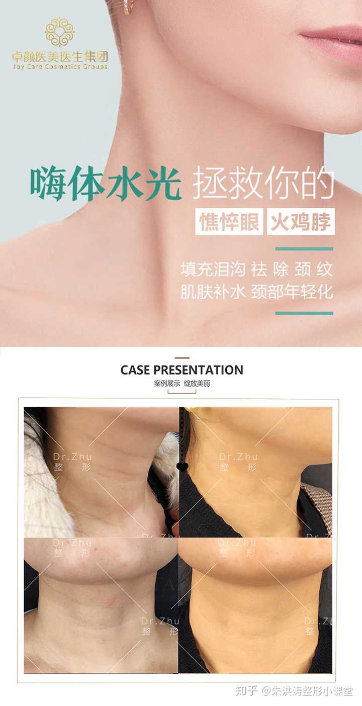请问我这个颈纹怎么办?