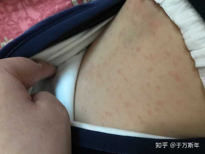 我家小孩最近幼儿急疹,作为八零后为什么我们的父母都不知道幼儿急疹