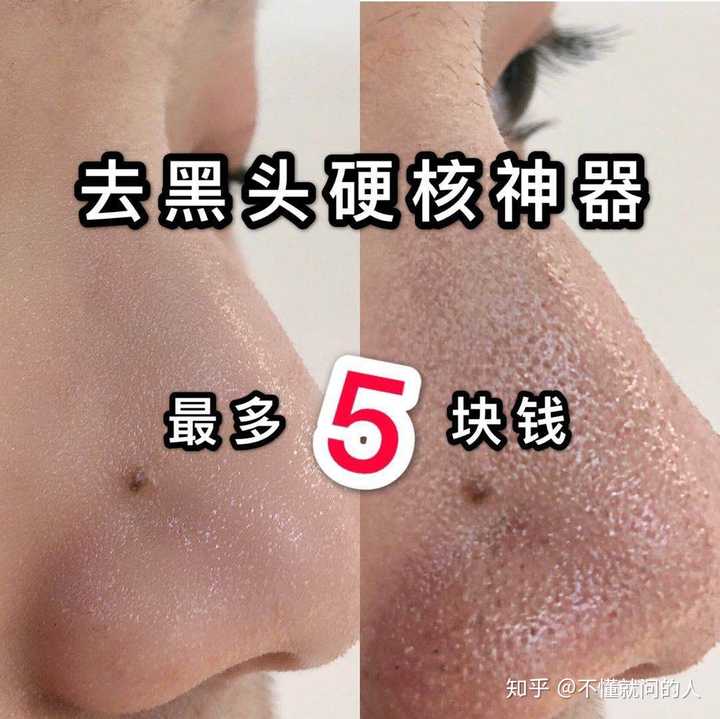 如何去除鼻子上的黑头