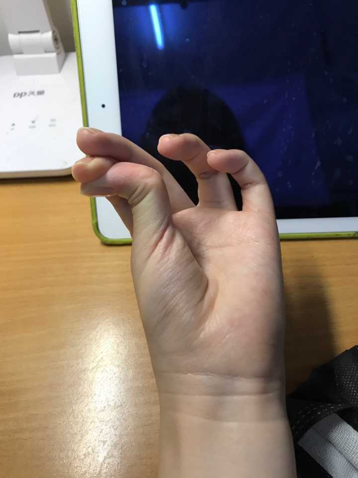 emmm 大拇指可以弯成这样. 同学说像骨折了.