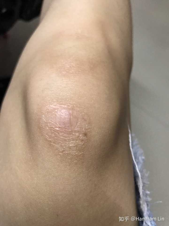 膝盖摔伤留下黑色的凸起疤痕,怎么修复淡化?已经2个多