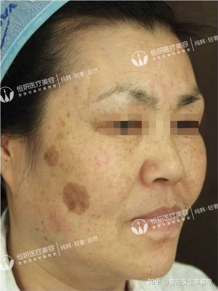 咖啡斑现在有什么新技术能治疗吗?