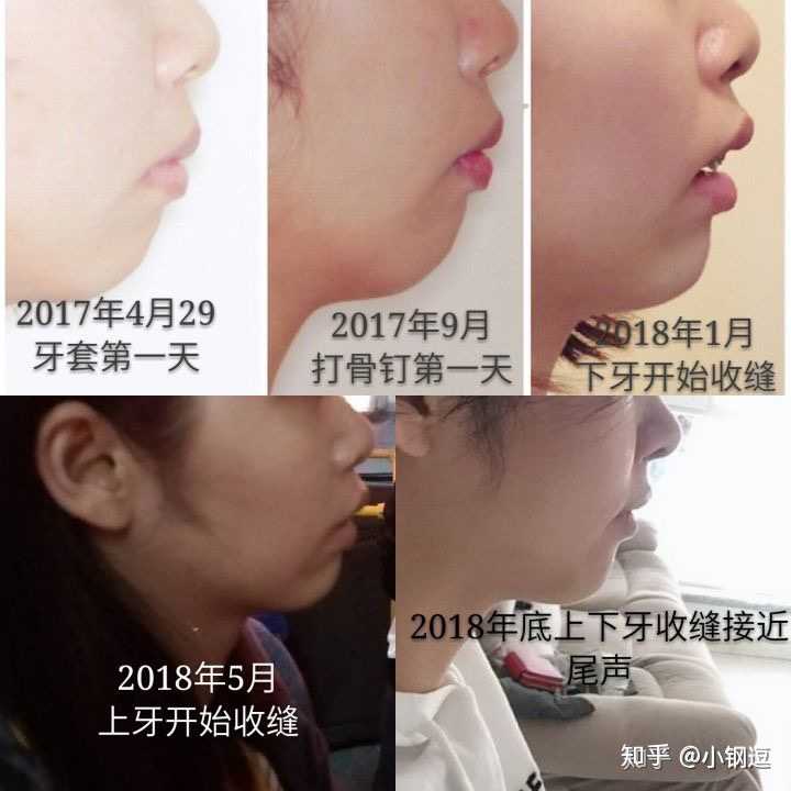 戴过牙套(矫正牙齿)的人脸型变了吗?