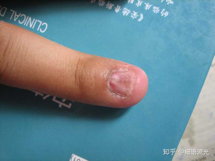 甲床变短损坏,指尖及甲周皮肤常被咬得血肉模糊;若在夏季,手指头常有