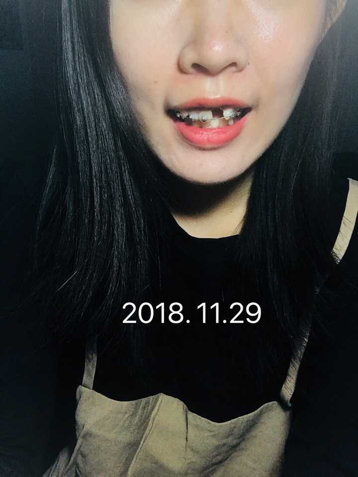没有门牙是怎样的体验?