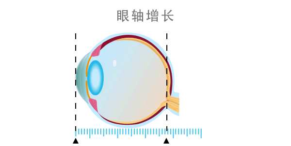 033mm的,现在是0.083mm,眼轴的增长速度比正常孩子快了2.5倍.