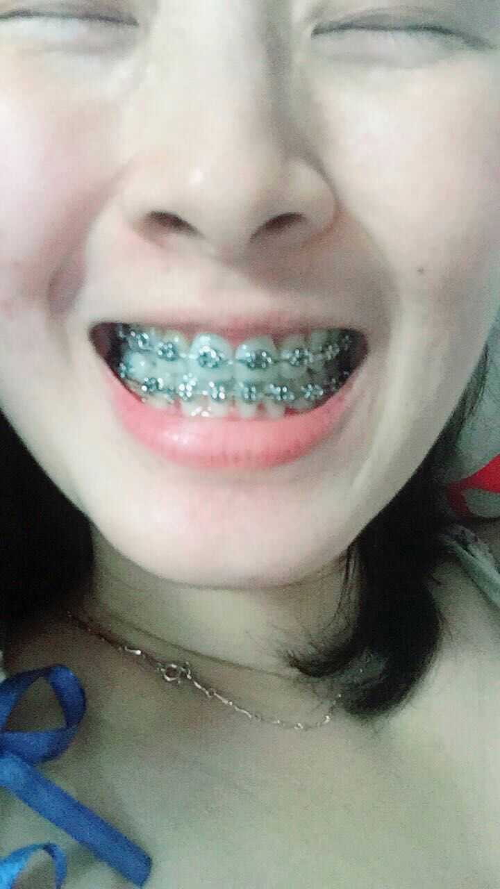 戴牙套带来的容貌的大改观是怎样的体验?