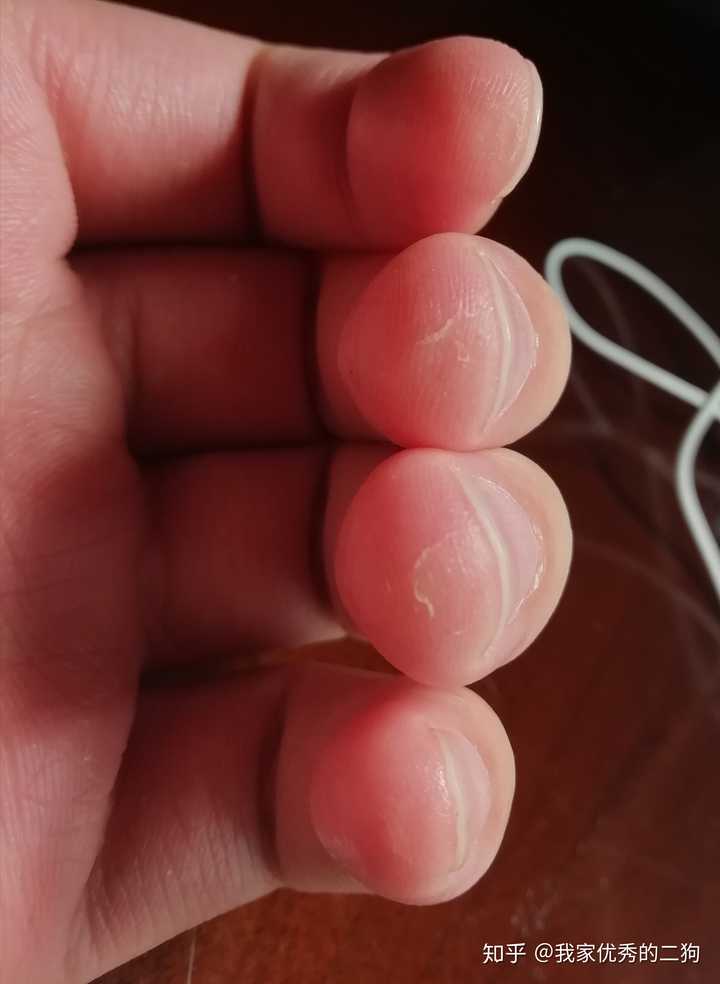 练吉他的时候左手按弦手指尖疼而且爆皮了怎么办?