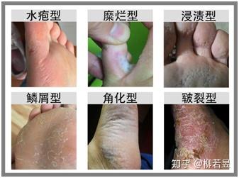 脚气主要有瘙痒,糜烂,水泡,脱皮,角化,烂脚丫等症状.