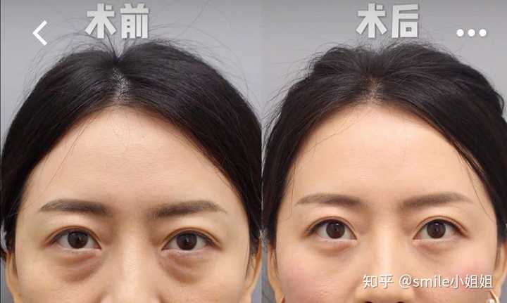 五,提眉术